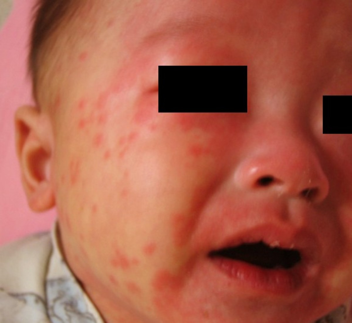 Kawasaki Disease Pictures, Symptoms, Contagious, Causes, Treatment