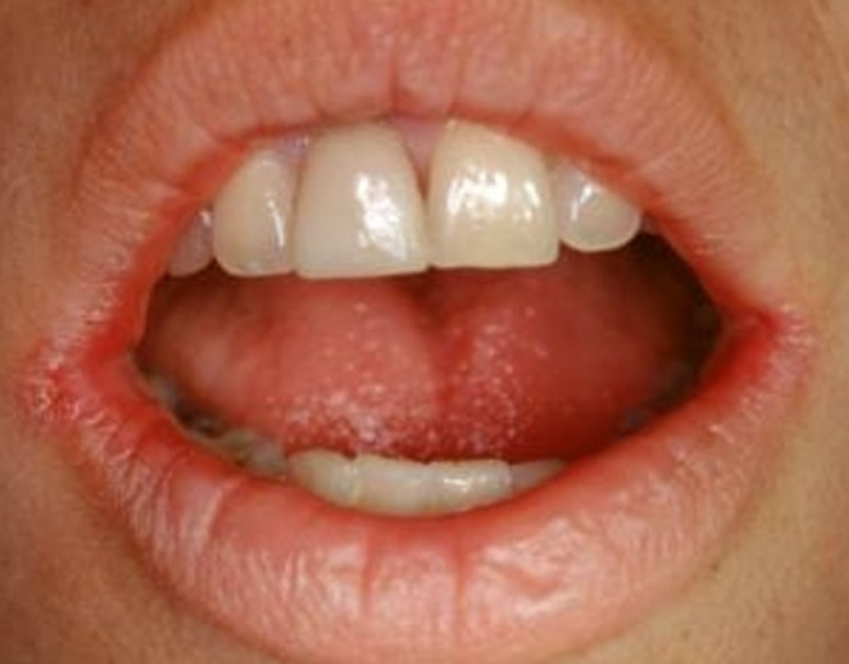 Splits at Corners of Mouth...Stop The Pain and Cure Angular Cheilitis
