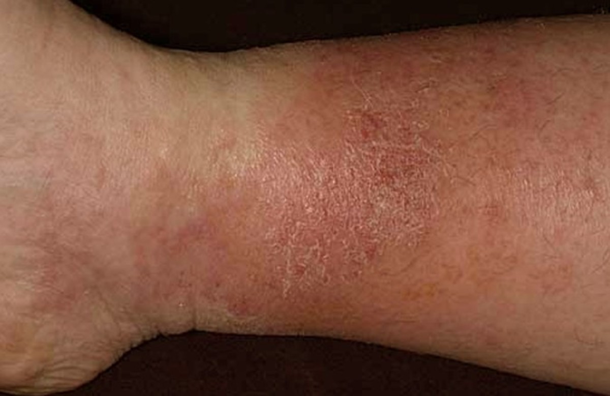 Stasis Dermatitis Pictures, Symptoms, Causes, Treatment, Diagnosis