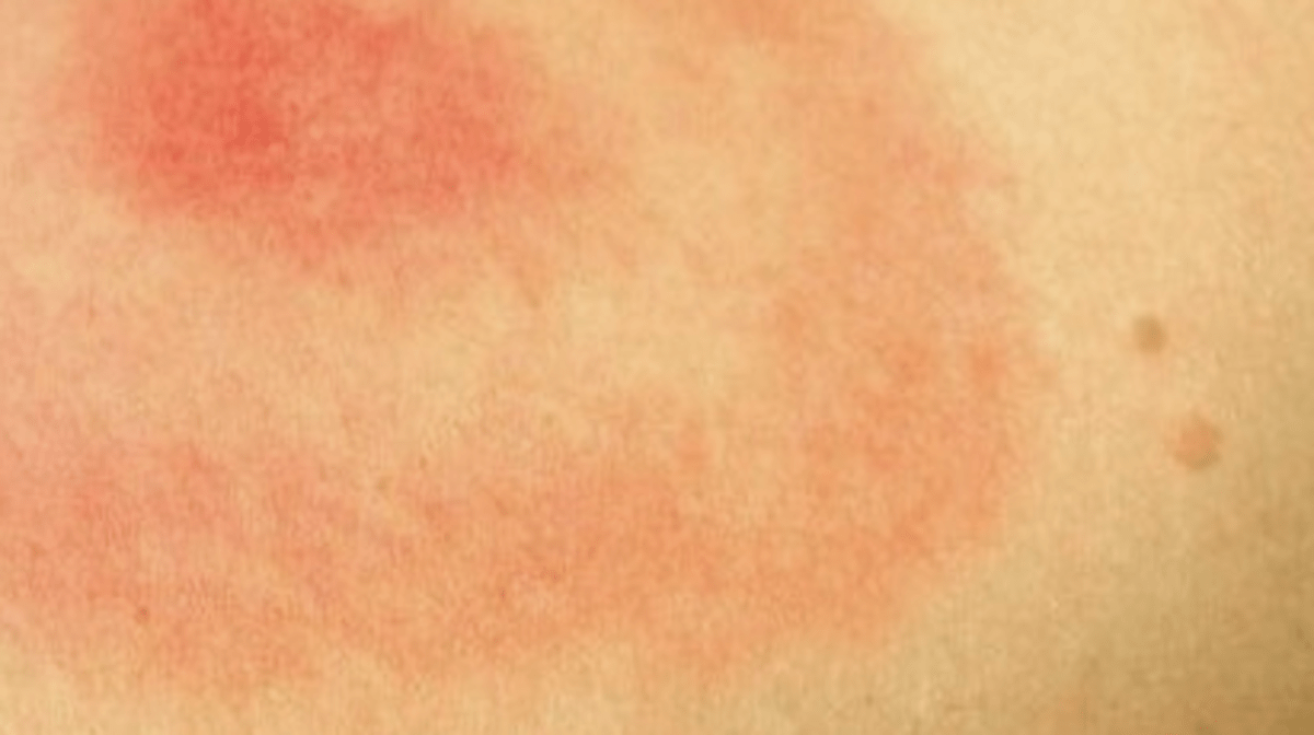 Lyme Disease Rash Pictures, Test, Symptoms, Causes, Treatment HubPages