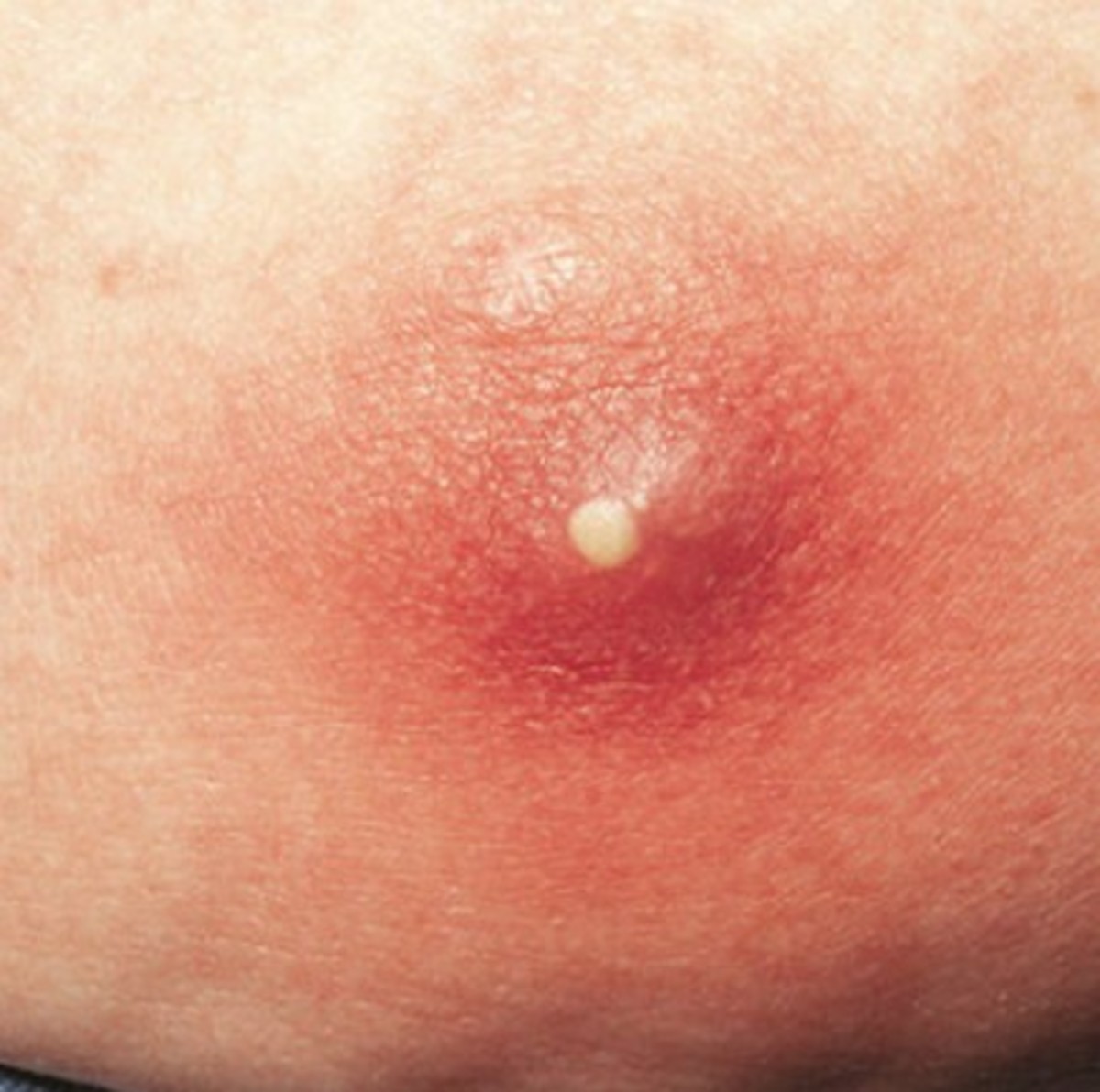 Furunculosis Pictures, Causes, Symptoms, Treatment HubPages