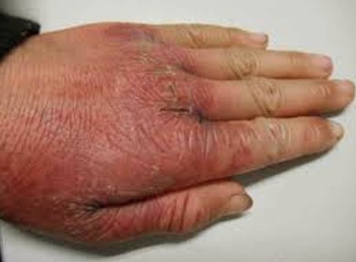 Pellagra Pictures, Symptoms, Treatment, Causes, Diagnosis HubPages