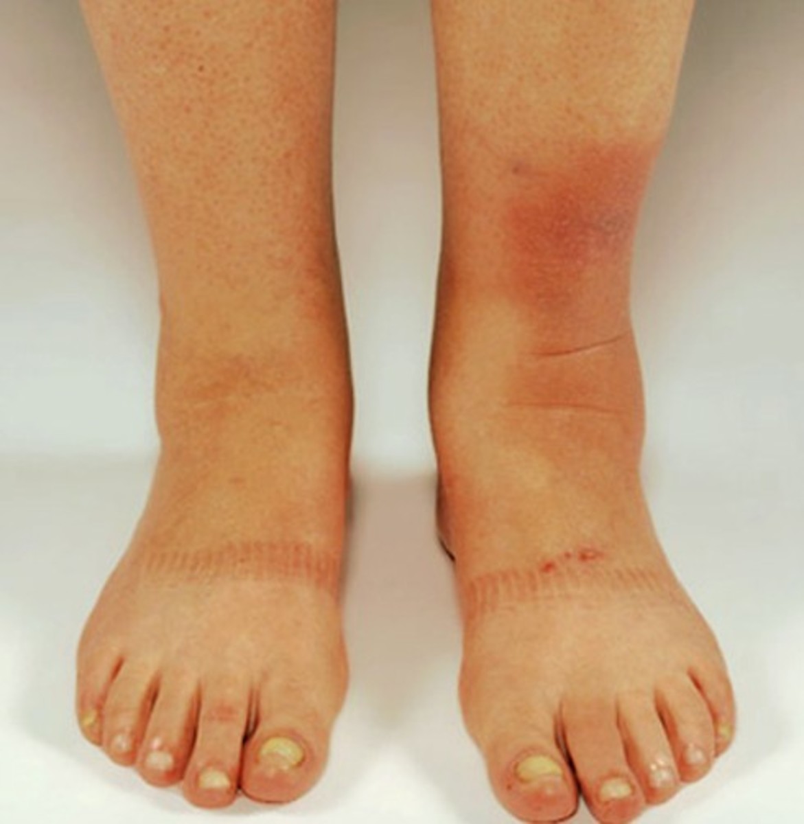 Pretibial Myxedema Pictures, Treatment, Symptoms, Causes