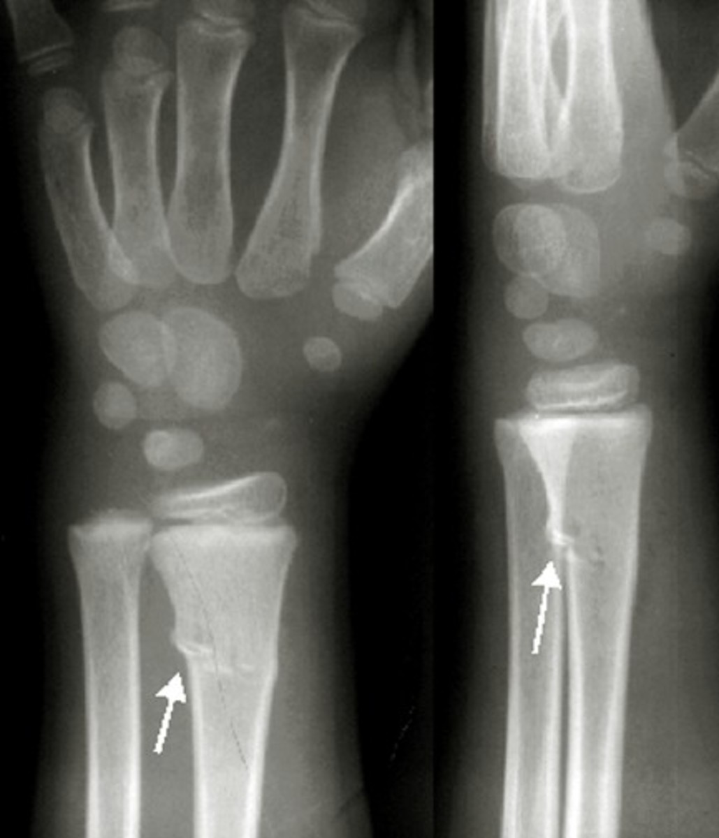 Greenstick Fracture Pictures, Treatment, Symptoms, Healing Time