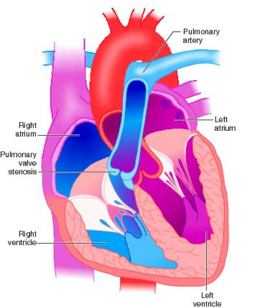 Acquired Lesions Of The Pulmonary Valve hubpages