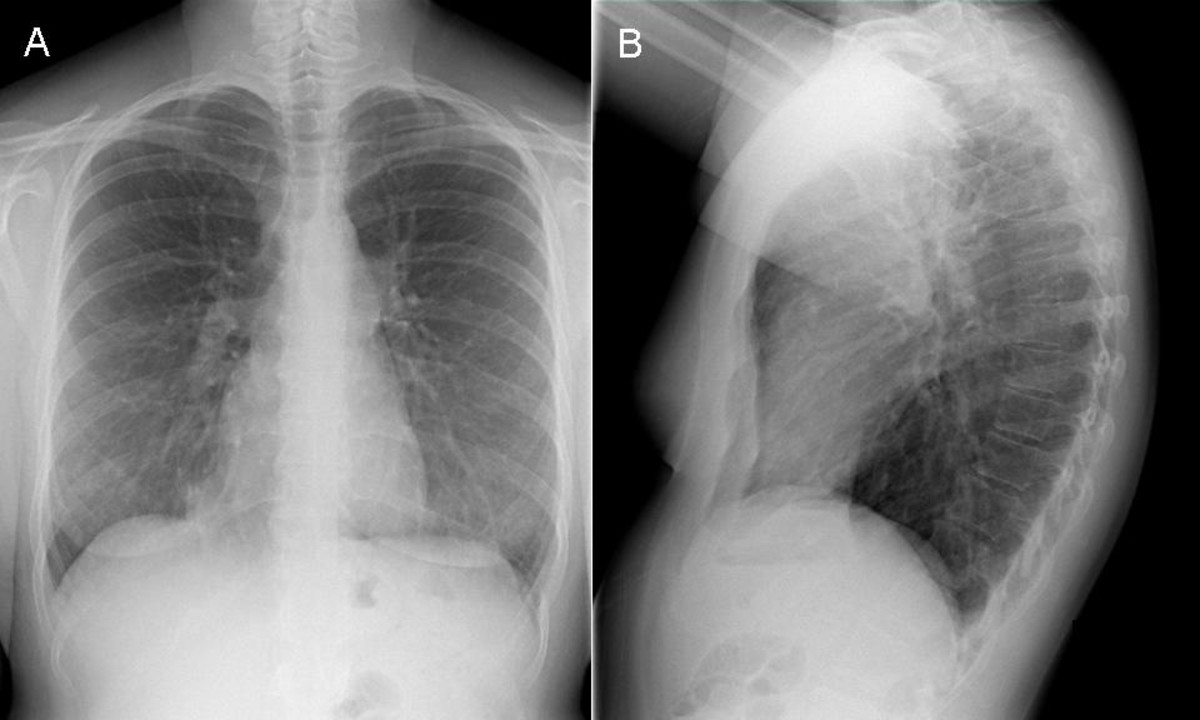 Reading The Chest XRay (Chest Radiography) Identifying A Normal Chest XRay HubPages