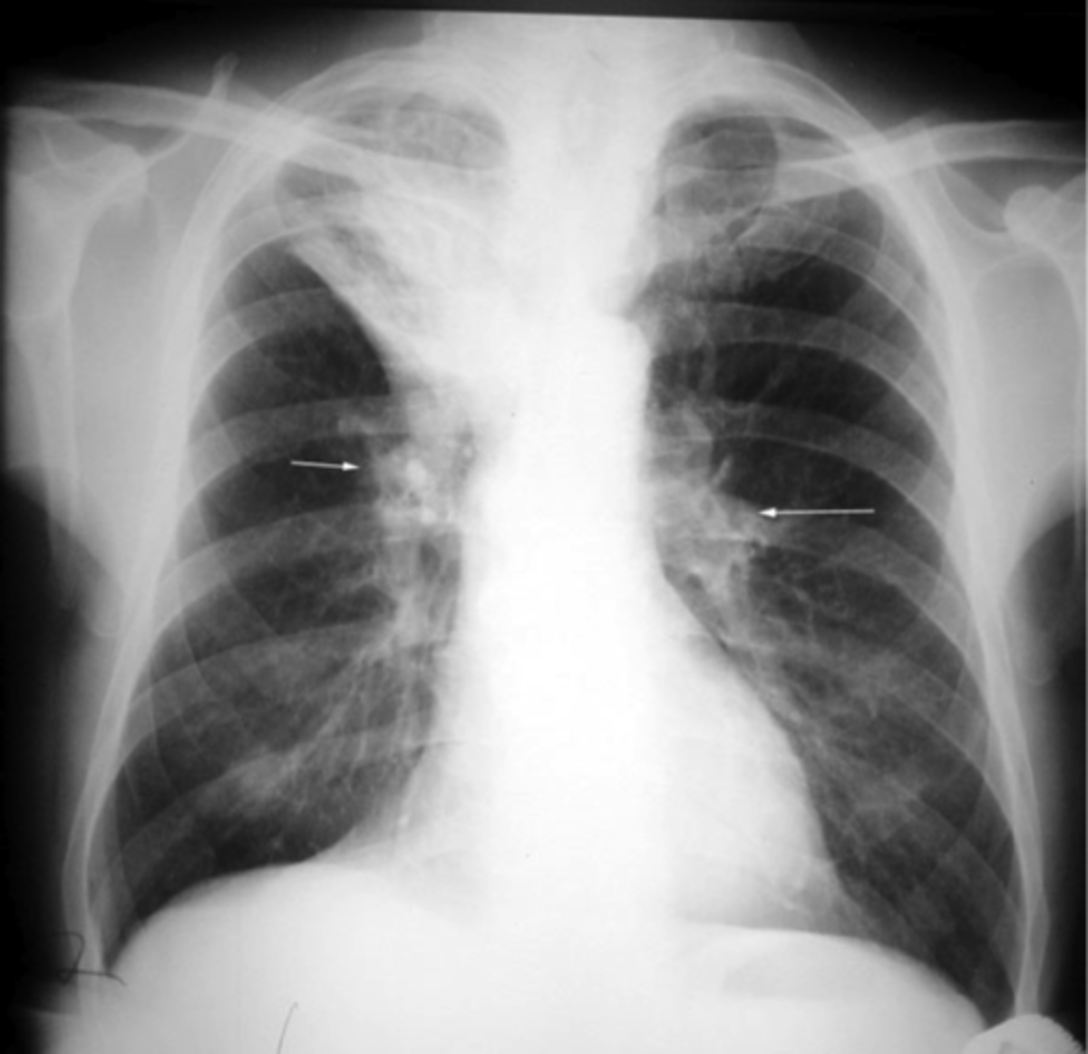 Diagnosing, Acquainting And Identifying With Atelectasis Via An XRay
