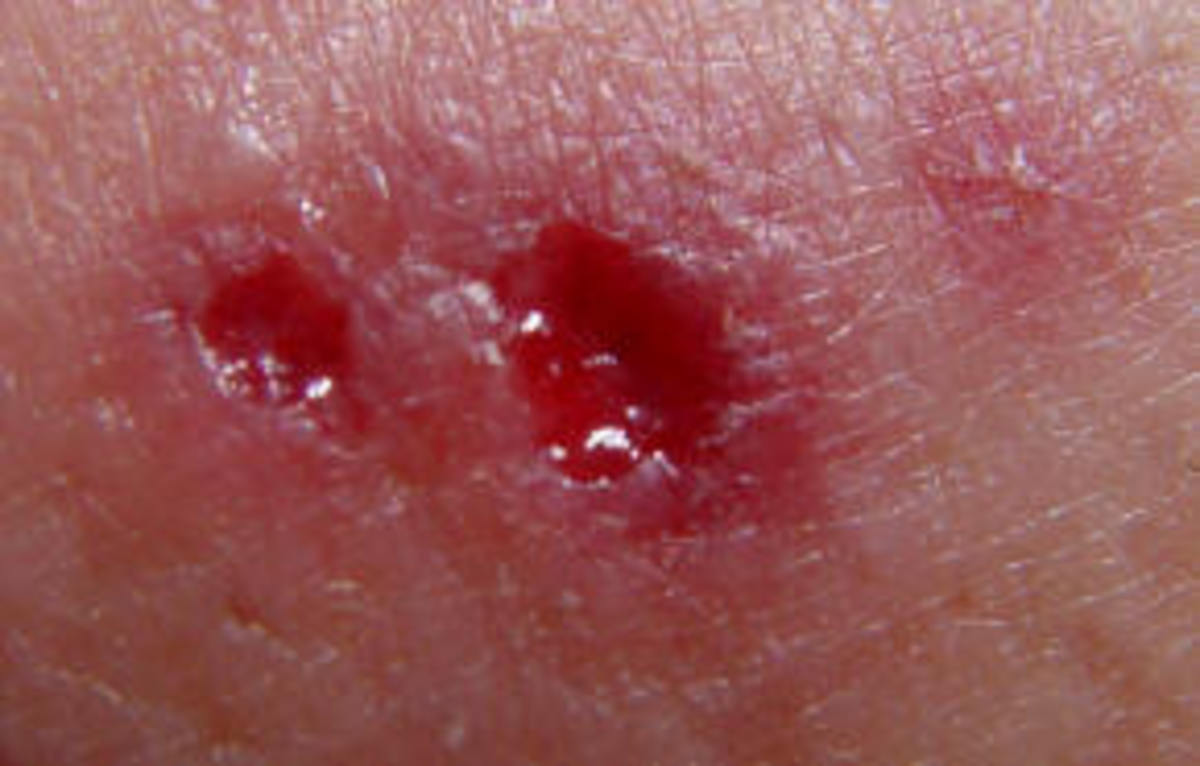 Wolf Spider Bite What You Need To Do?