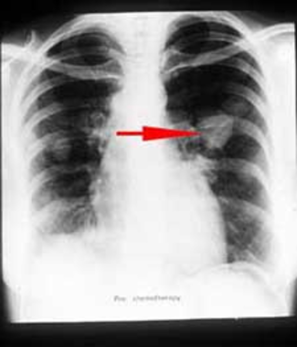Radiographic Representation Of Lung Cyst (Lung Cancer) Through Various