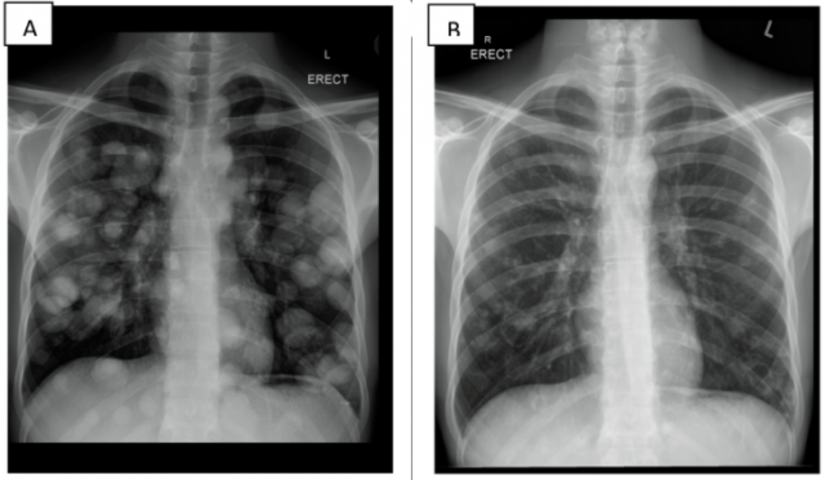 Radiographic Representation Of Lung Cyst (Lung Cancer) Through Various