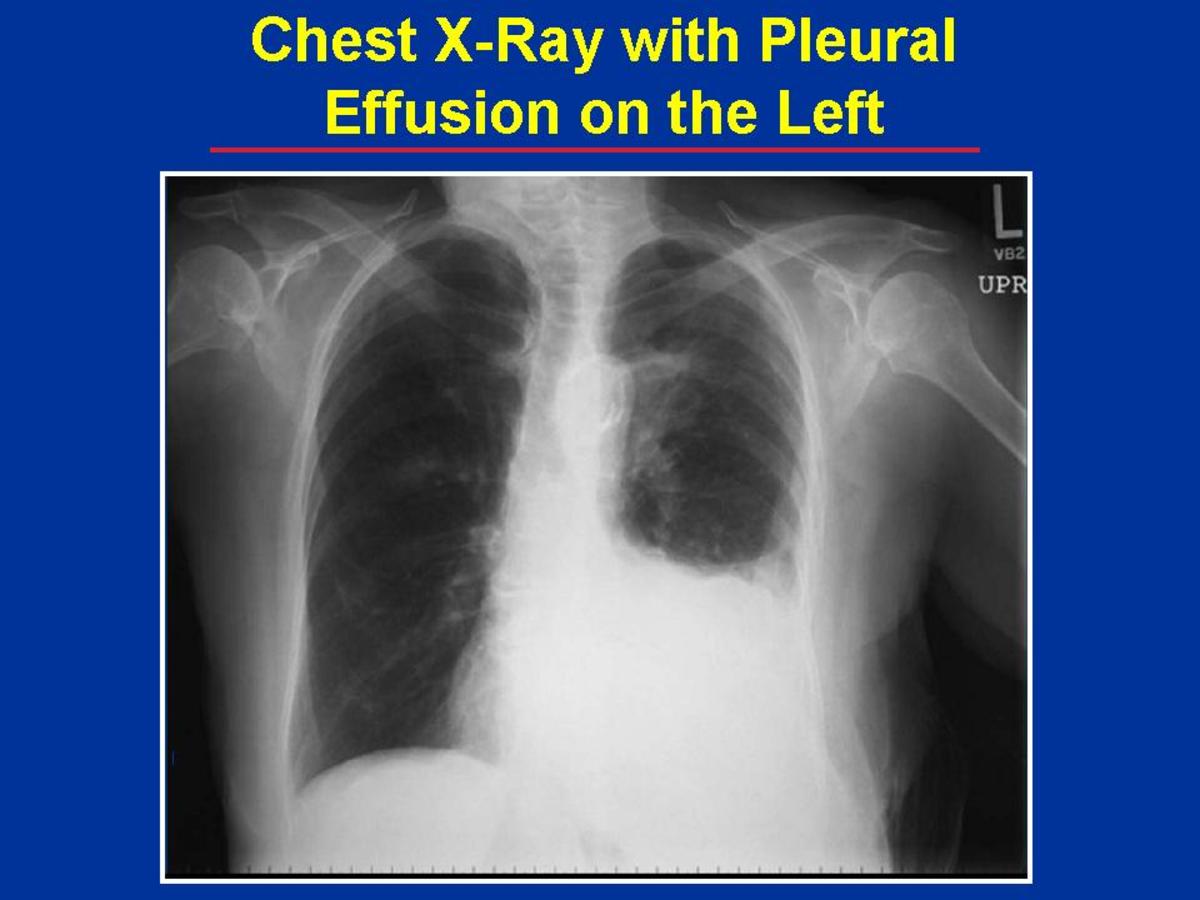 Different Radiographs To Depict And Show Pleural Effusion In Affected