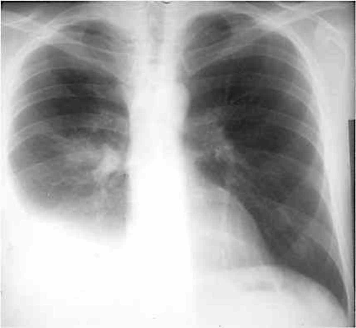 Pleurisy In Chest XRay Various Radiographs To Show And Depict This Respiratory Disorder hubpages