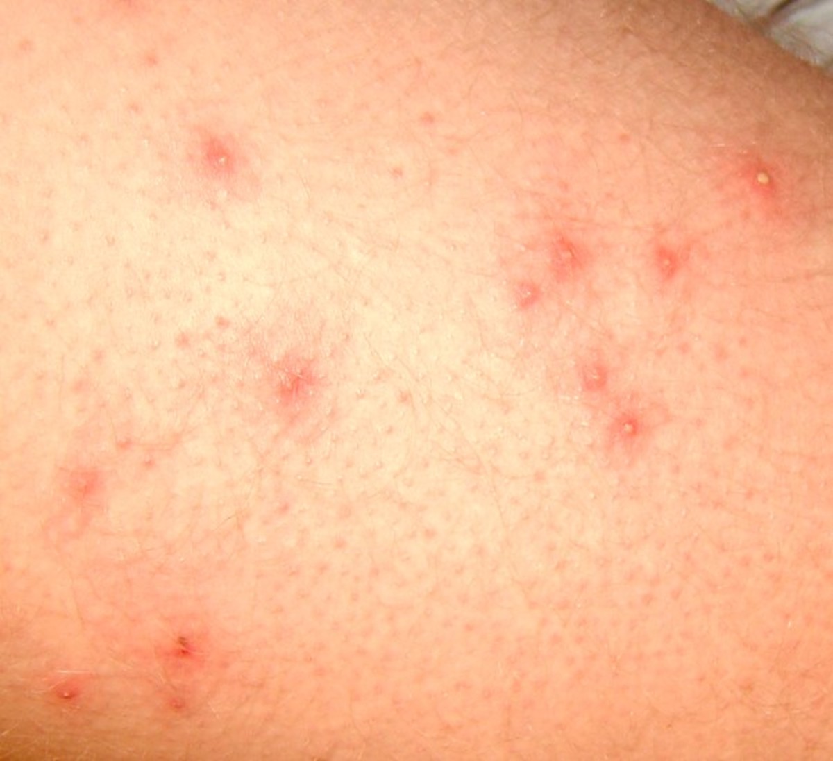Folliculitis Pictures, Symptoms, Causes, Treatment hubpages