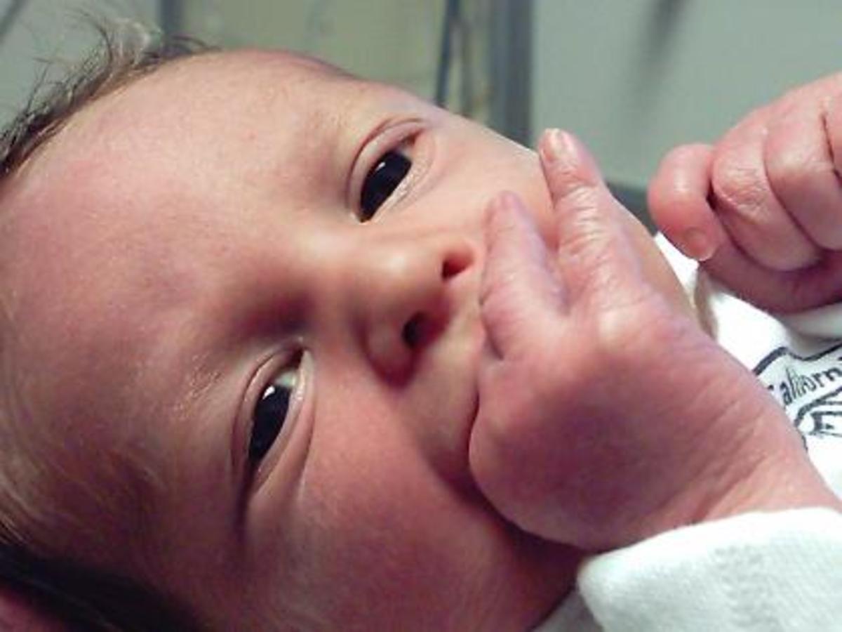 Hemochromatosis (Bronzed Diabetes) Pathogenesis, Clinical Manifestations, Prognosis, Diagnosis