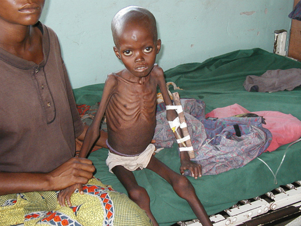 Protein Energy Malnutrition Marasmus And Kwashiokor, Clinical Presentations, Pathology And
