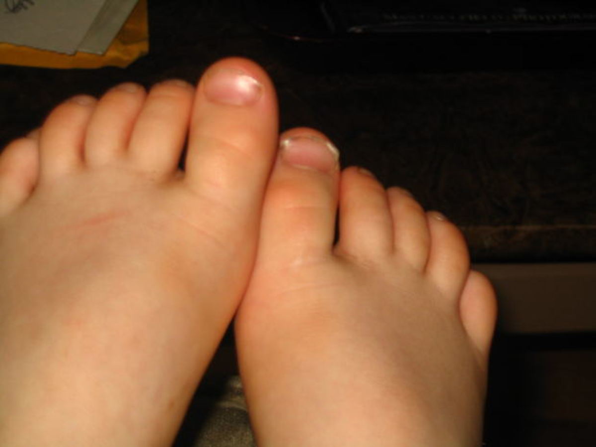 Mixed Connective Tissue Disease Life Expectancy HubPages