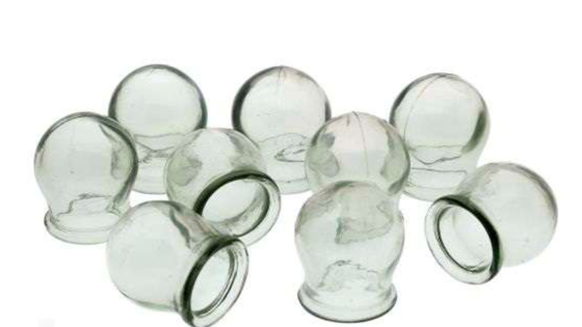 What you need to know about Cupping Therapy HubPages