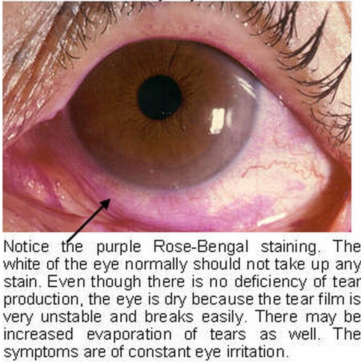 Spotlight On My Life With Sjogren's Syndrome hubpages