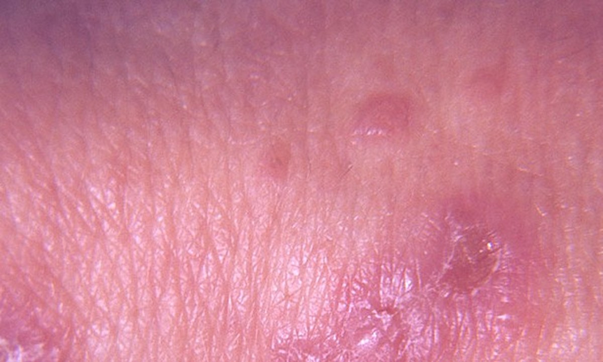 Dermatitis Herpetiformis Pictures, Symptoms, Causes, Treatment HubPages
