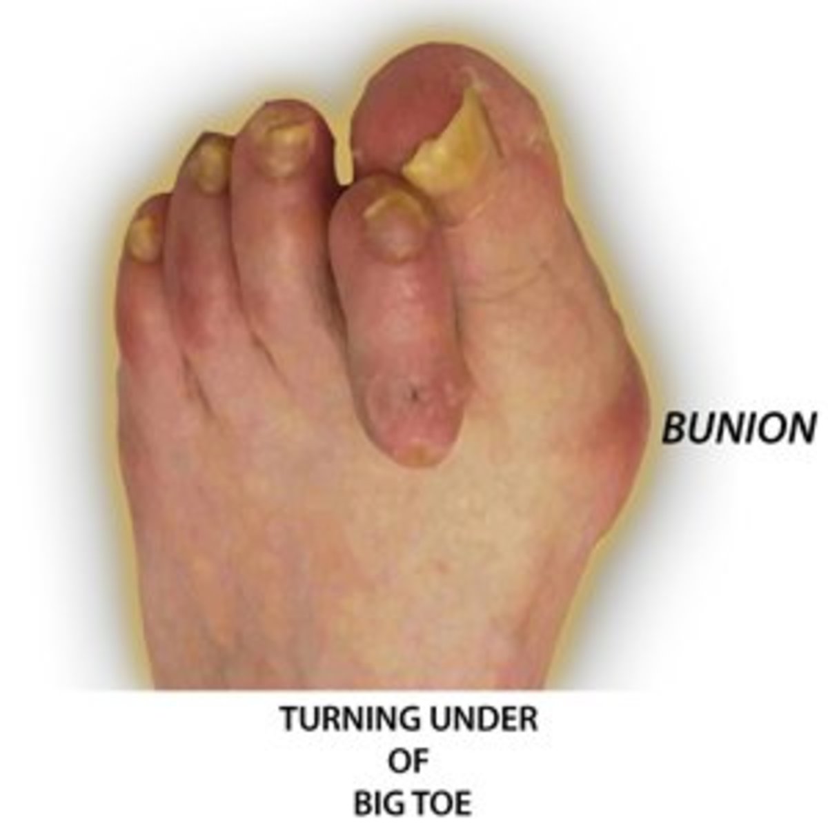 SUCCESSFUL NATURAL CURE FOR BONES (esp.deformities as