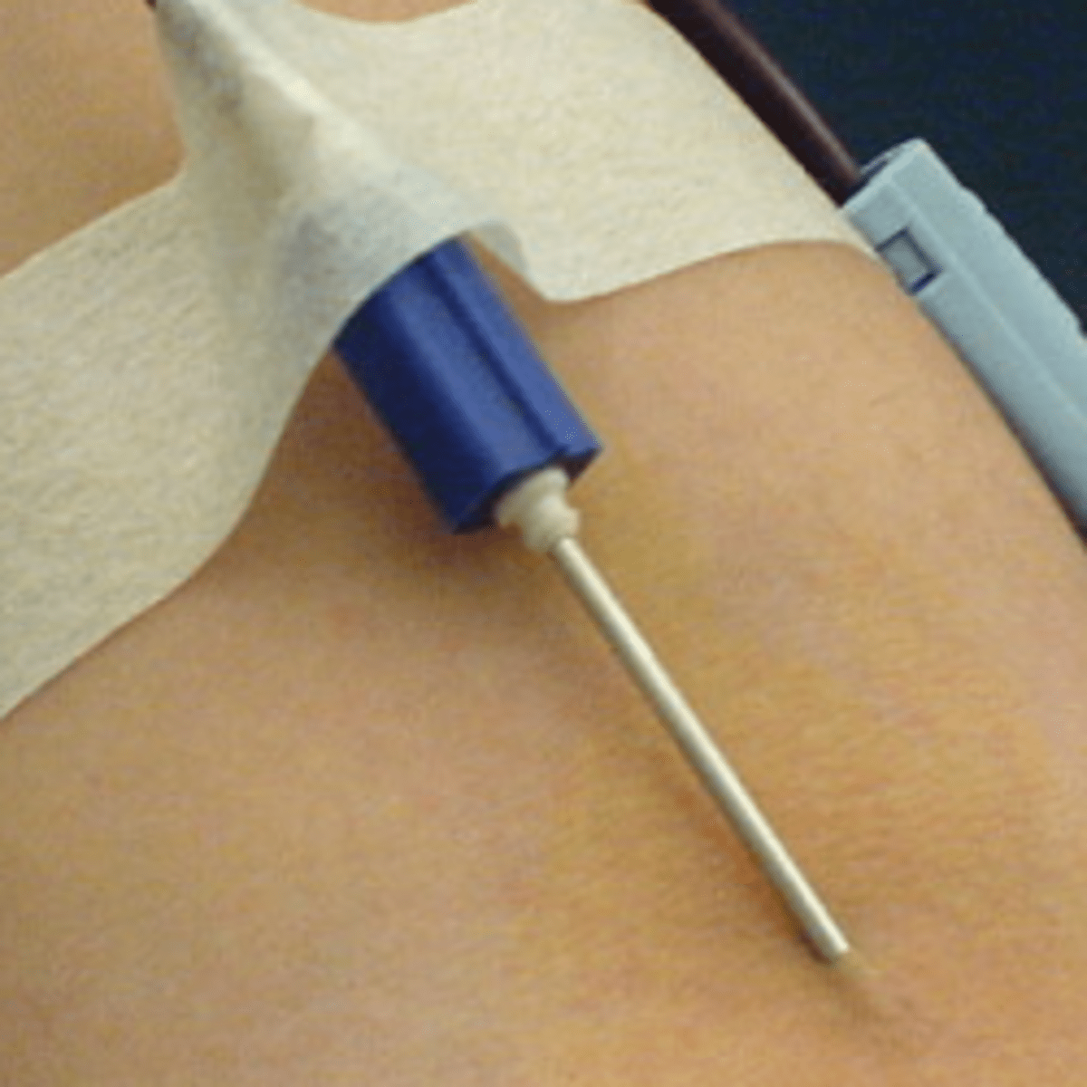 My Journey Through Kidney Failure and Transplantation HubPages