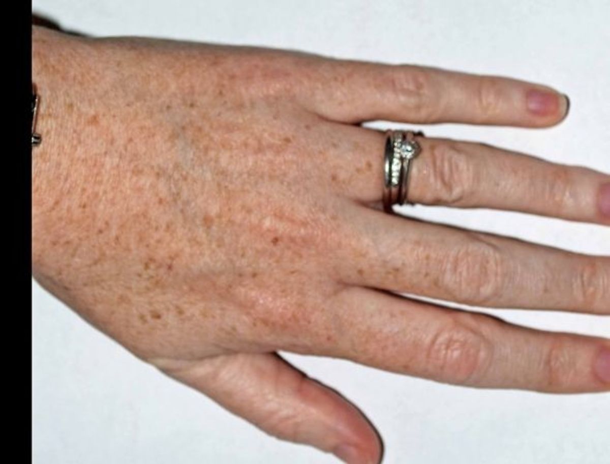 Age Spots How to Get Rid of Age Spots HubPages