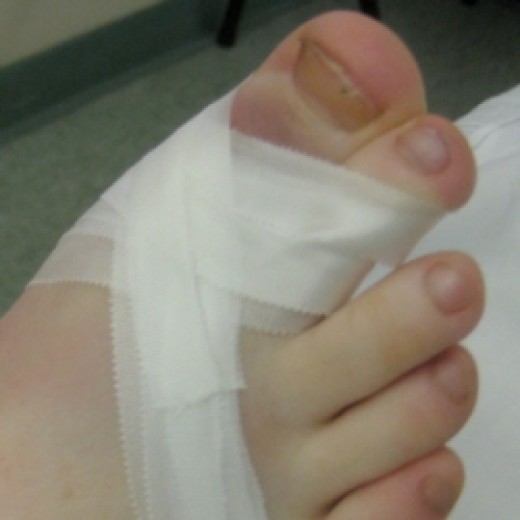 How to Straighten Crooked Toes Without Surgery HealDove