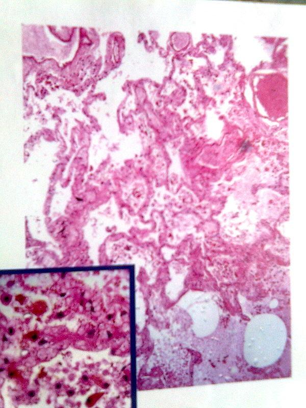 Chronic trapped wind General center