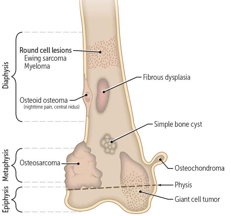 Primary Bone Tumors USMLERx