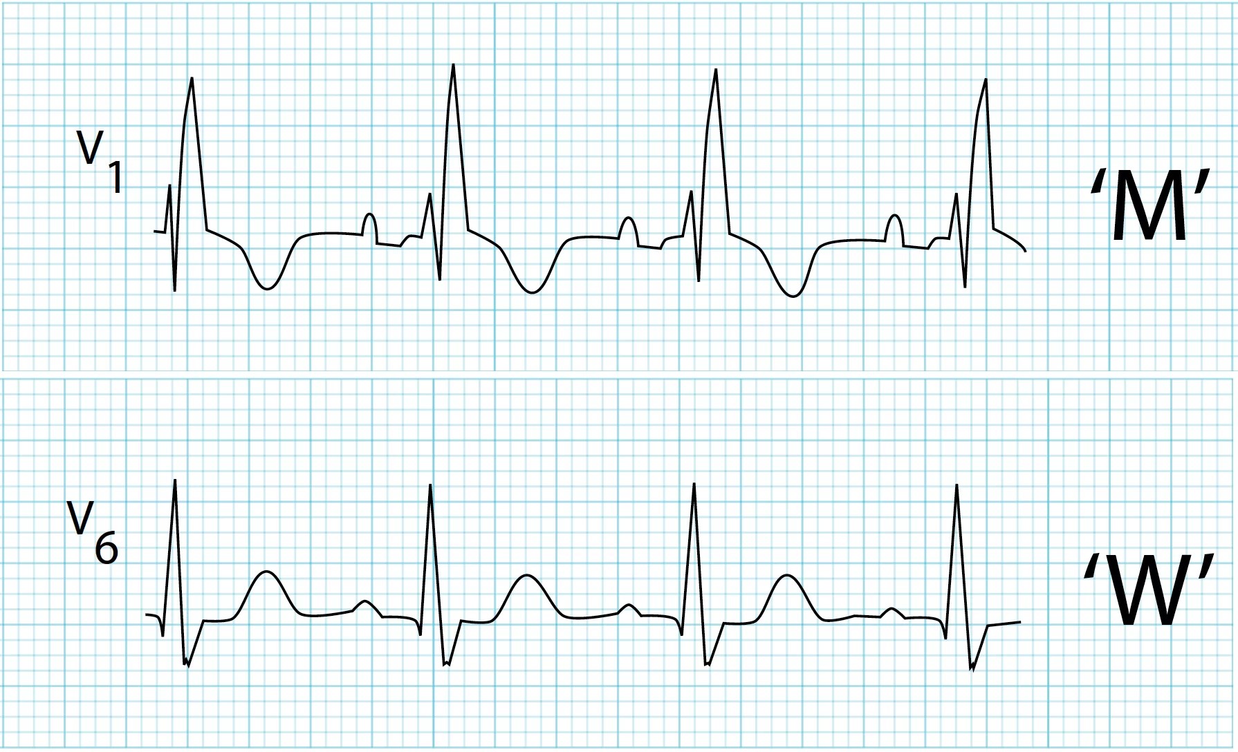 Right Bundle Branch Block Symptoms And Causes