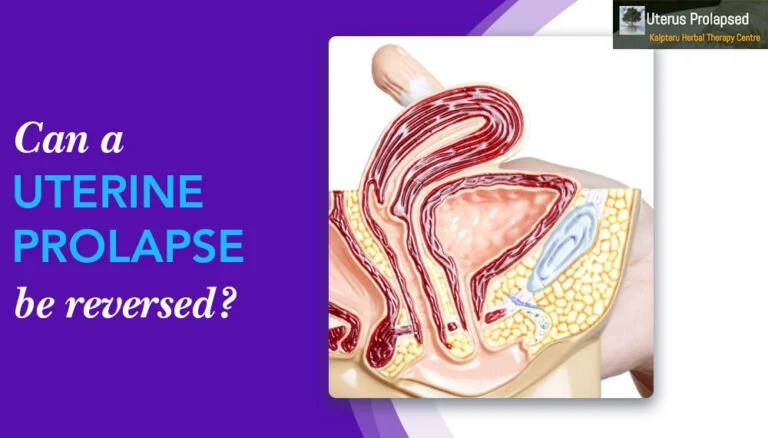 Prolapsed Uterus Treatment Uterus Prolapse Treatment in