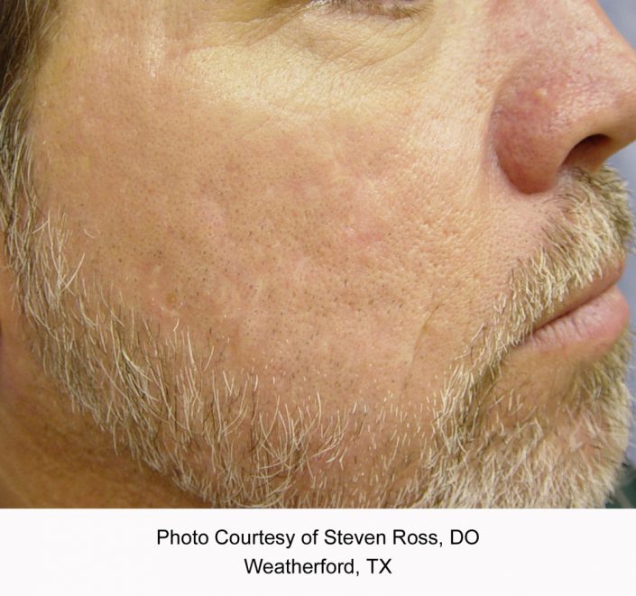 Cosmetic Dermatology Gallery Before and After Images