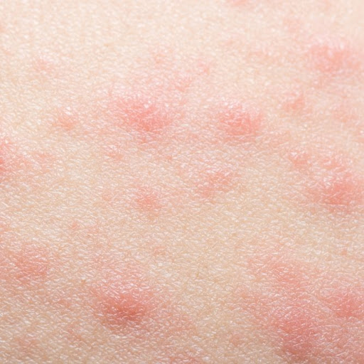 CONTACT DERMATITIS Utah Valley Dermatology