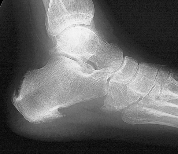 Spinal Spinal Enthesopathy