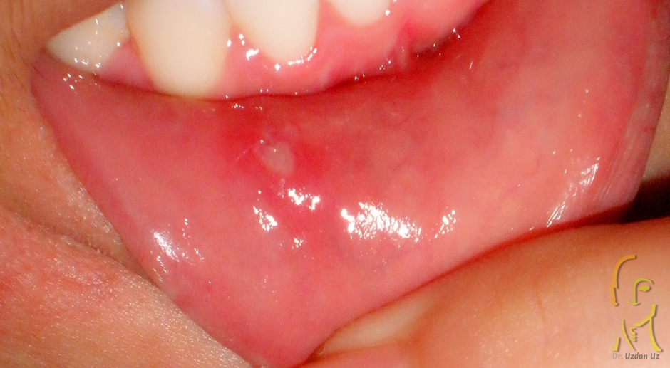 Ağız Yarası (Aft) • Doç. Dr. Uzdan Uz