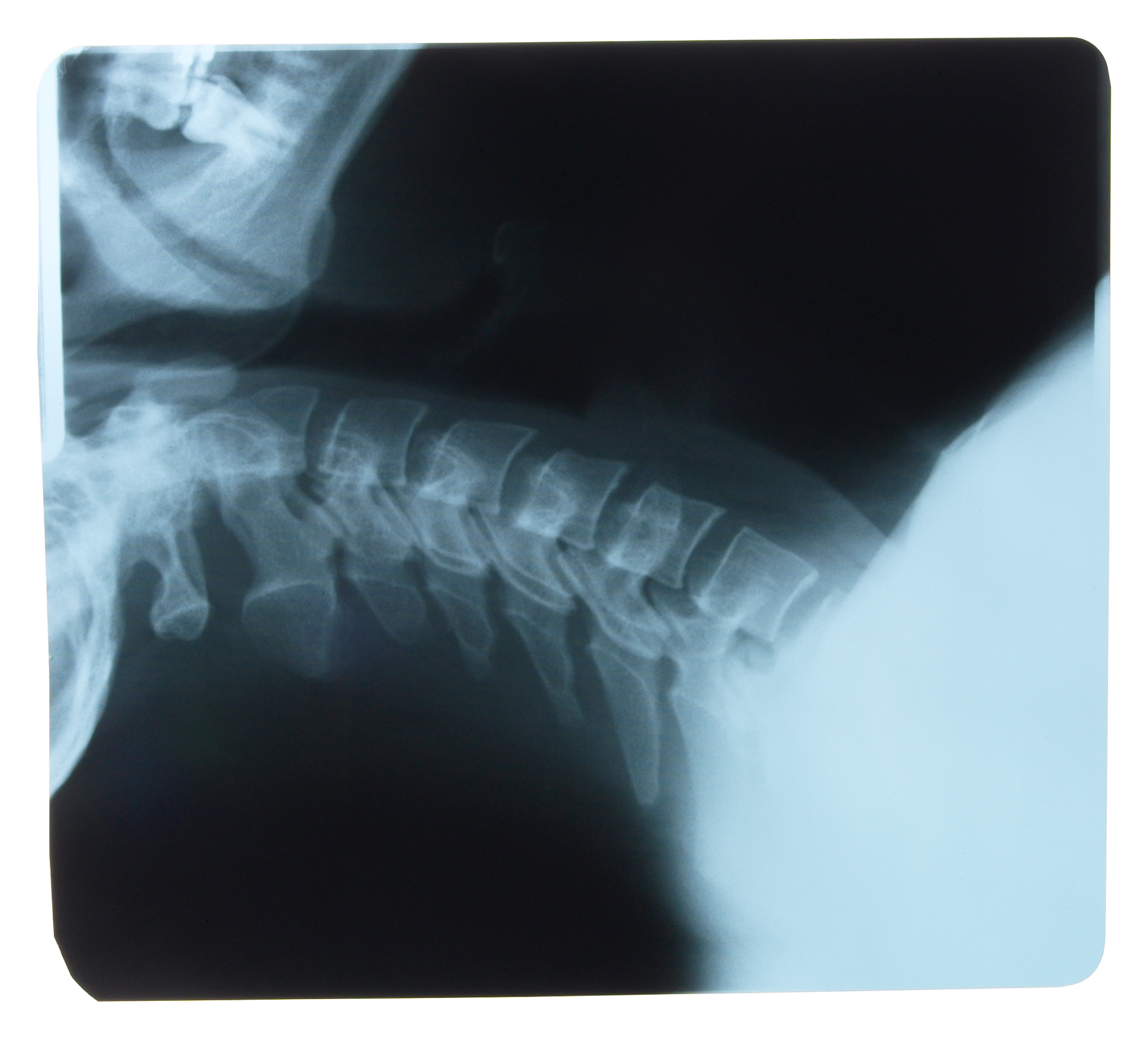 Why do Chiropractors do xrays? Joondalup, Perth Chiropractor