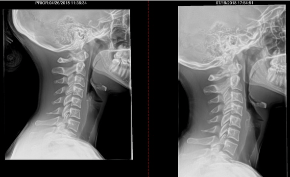 SAAT Acupuncture Alpha Gal Rolla, MO Chiropractor Moreland