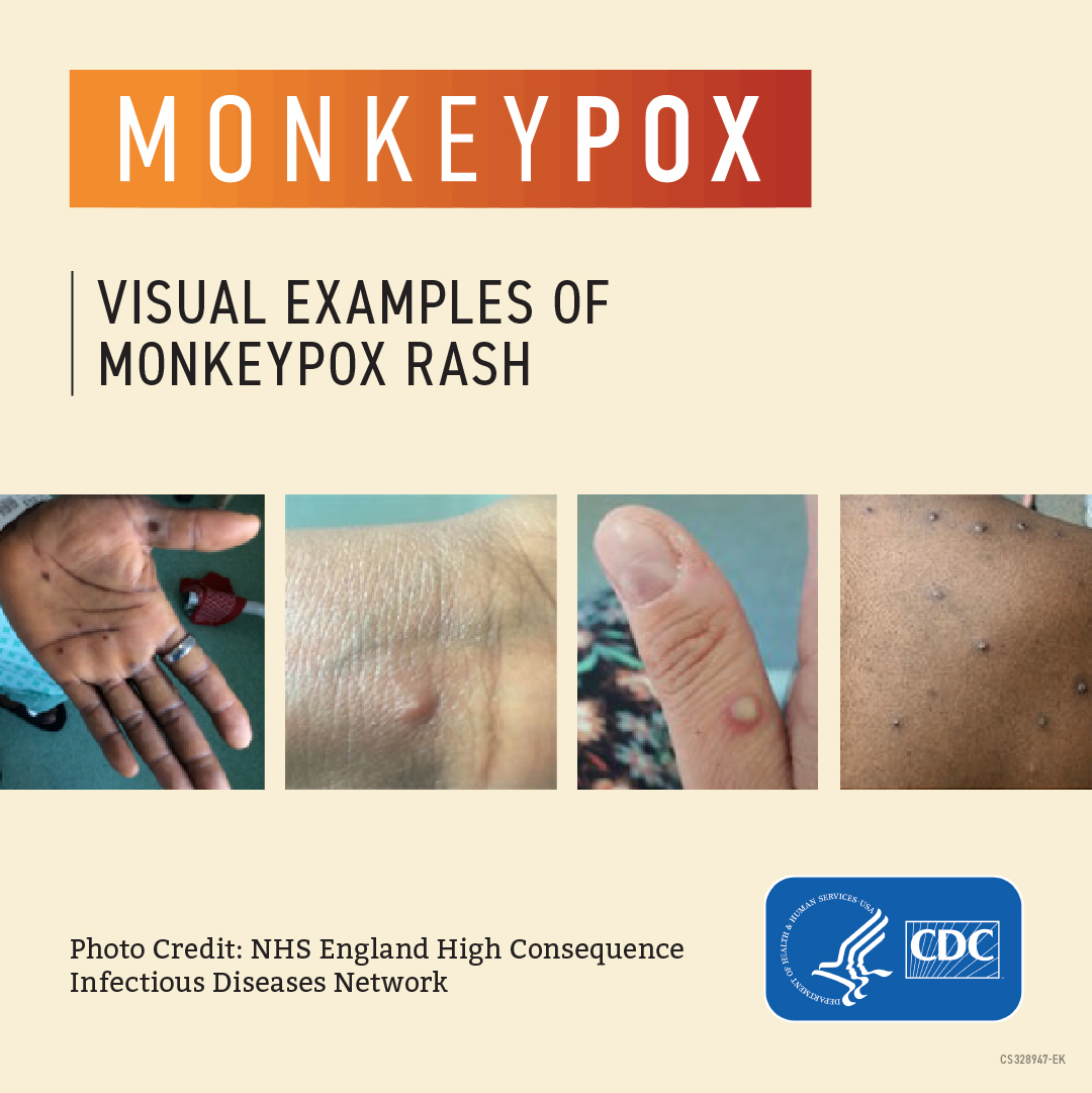 Social Media Graphics Provide Visual Examples of Monkeypox Rash