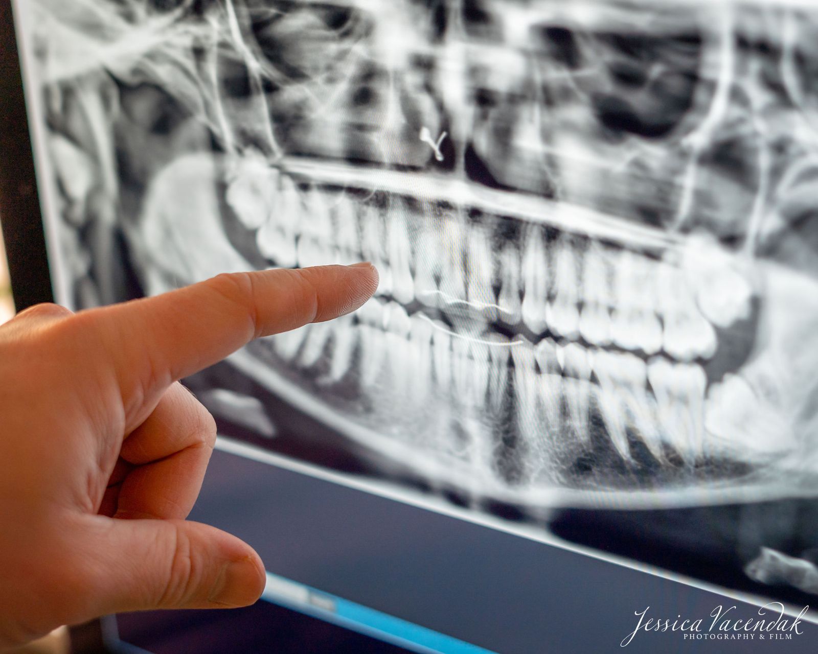 What Do Dental XRays Really Tell Us? Vacendak Dentistry