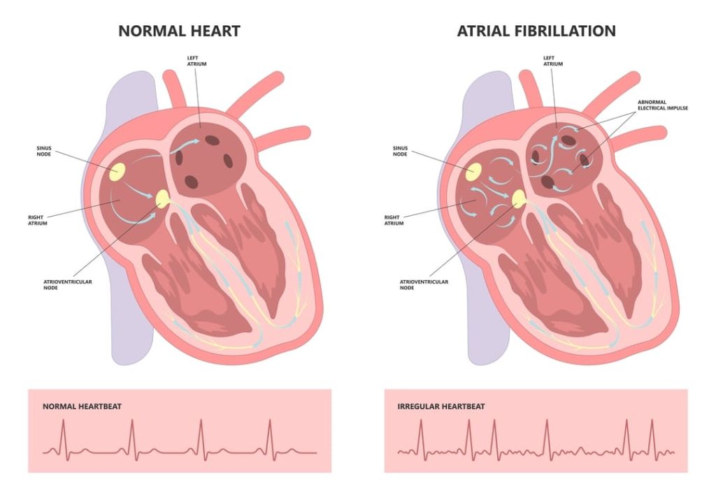 VA Disability For Heart Conditions