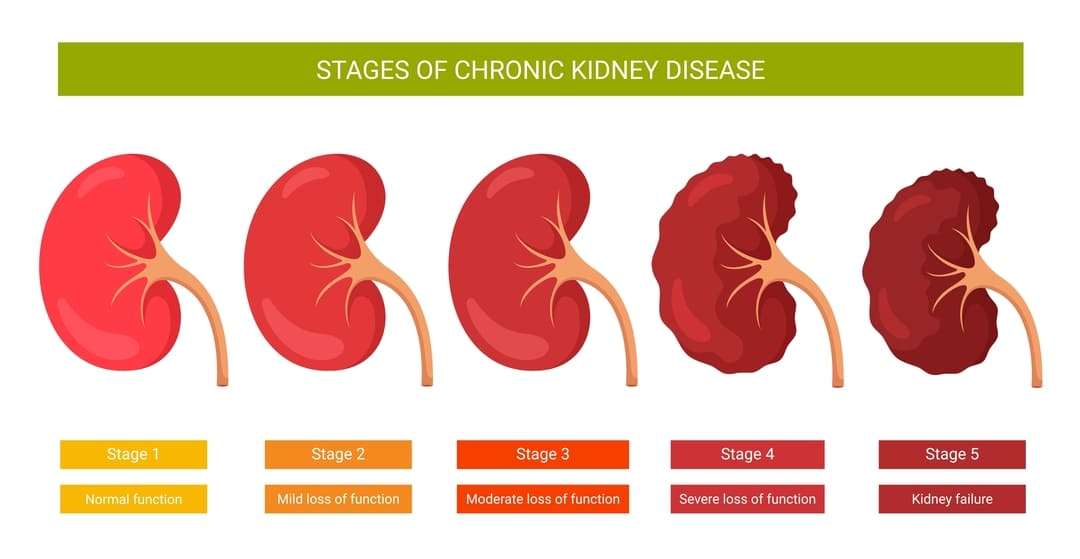 VA Rating for Kidney Disease (The Ultimate Guide)
