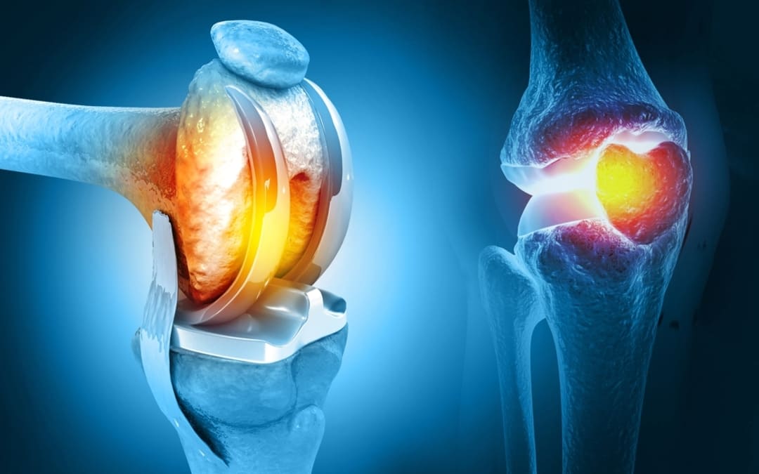 Knee Replacement VA Disability 5 Key Facts