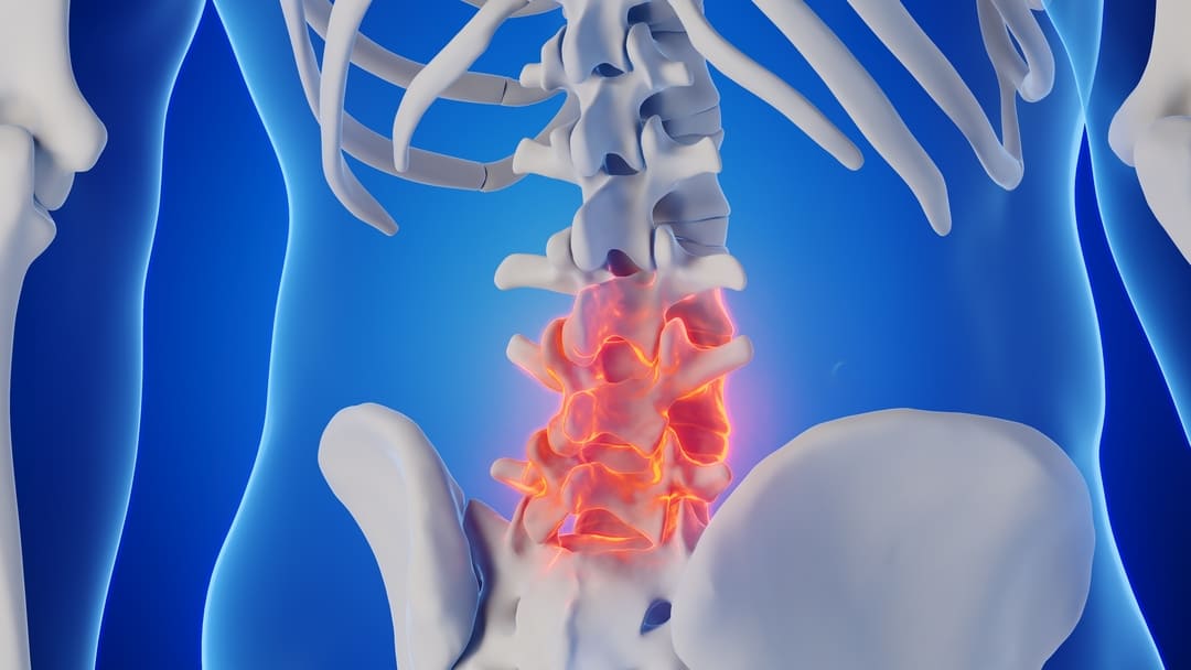 How to Get a VA Rating for Spondylosis [2024 Definitive Guide]
