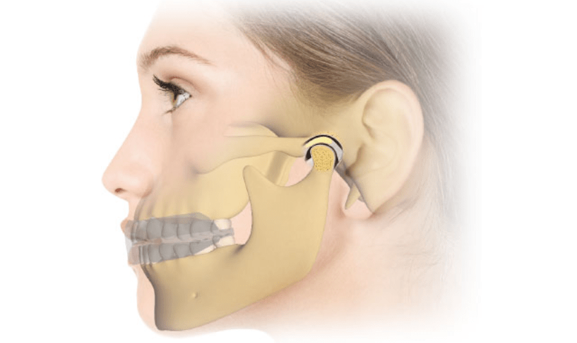 TMJ Splints & Orthotics Care Tips & Tricks