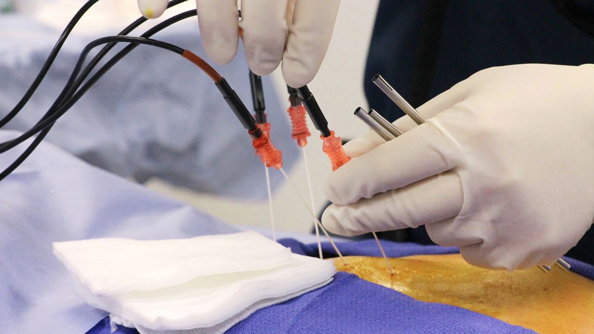 Barrett Oesophagus. The Endoscopy Ablation Valenia Health Services