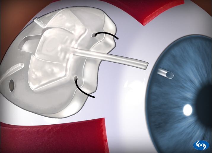 drainage device implant surgery Valenia Health Services