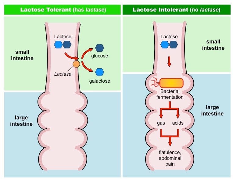 Lactose Intolerance Symptoms, Causes, Remedies