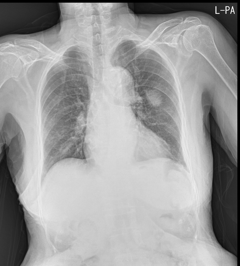 Chest AP view와 PA view의 차이 수면제의 까리한 시선