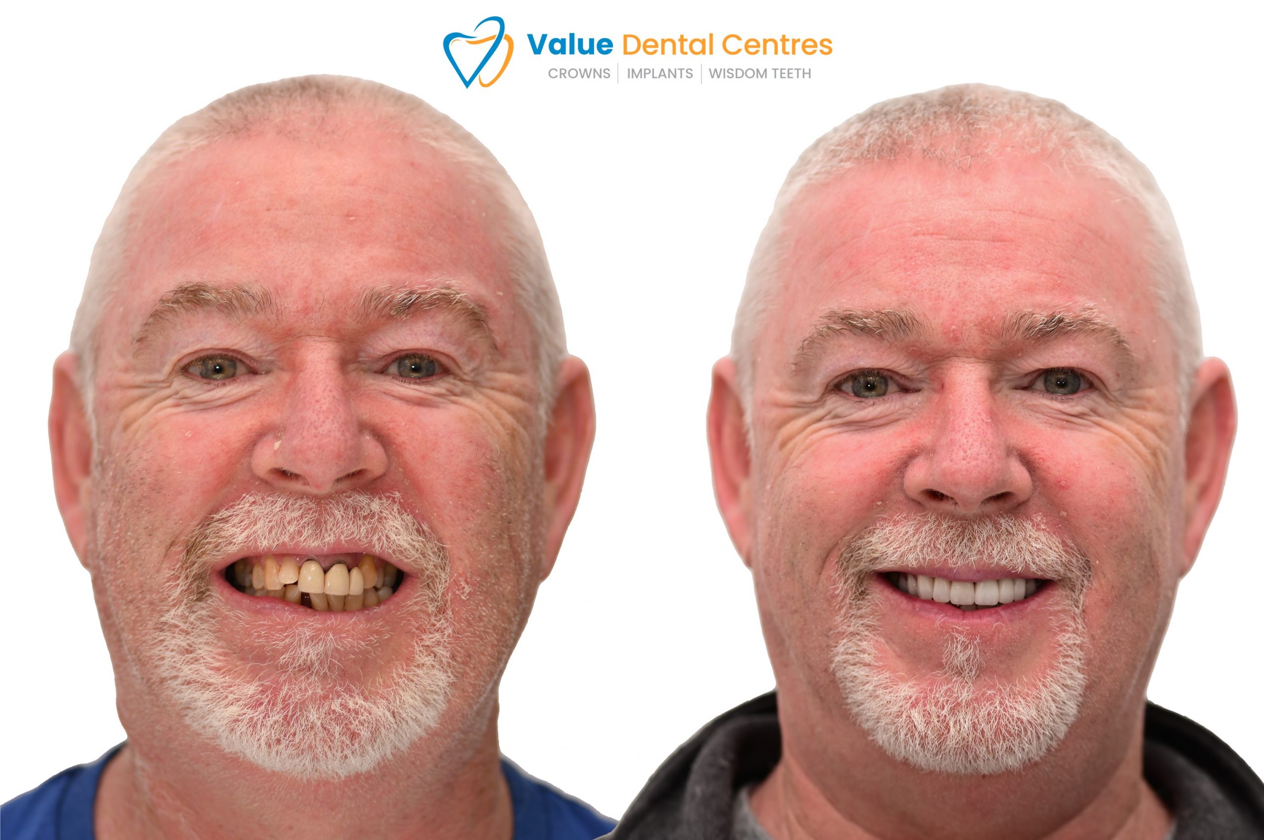 Affordable dental veneers Dental Veneer Prices Cheap