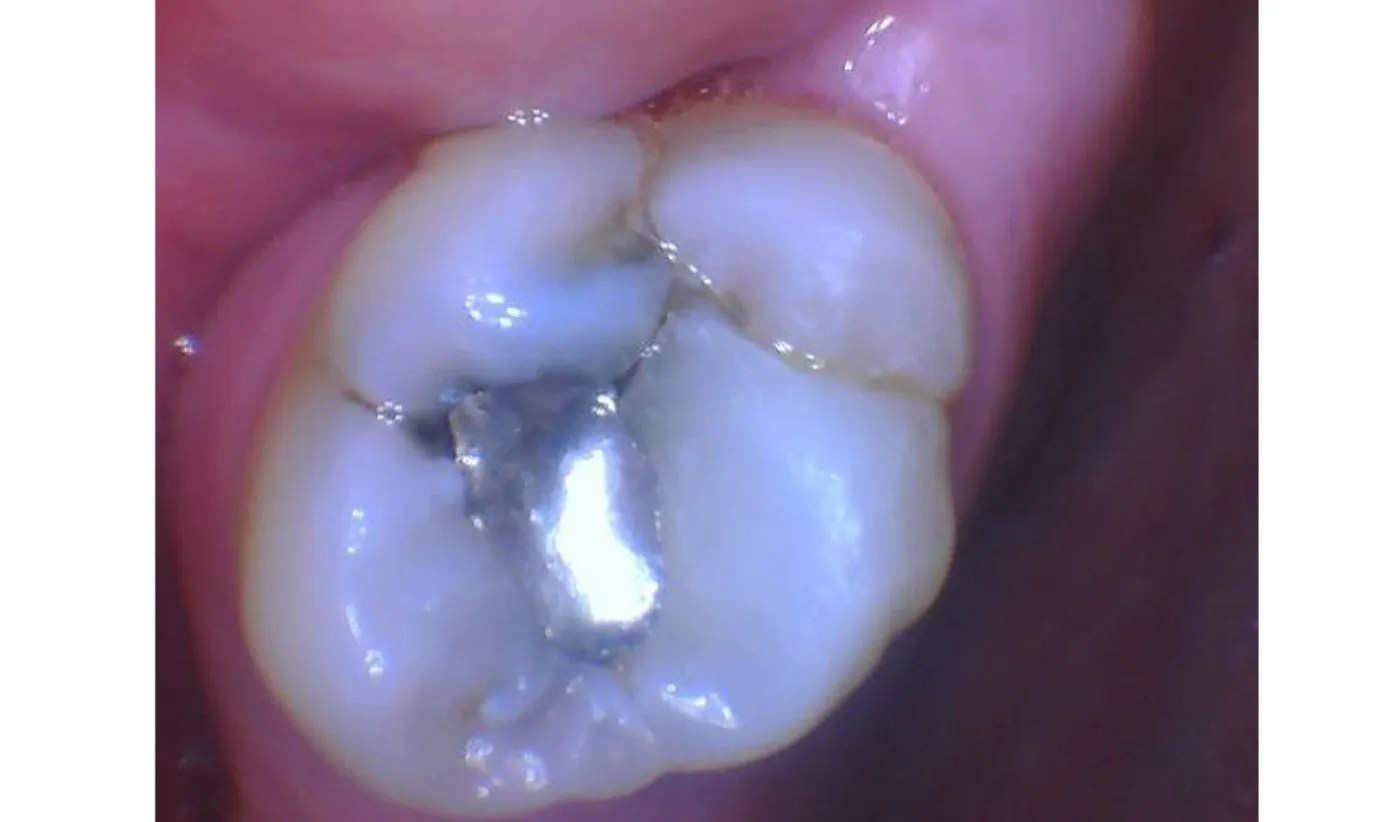 Update 50+ do amalgam tattoos go away latest vova.edu.vn